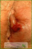 Bartholin's cyst