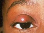 chalazion