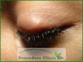 cyst chalazion