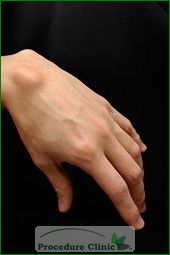 Ganglion Cyst