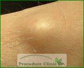Ganglion cyst