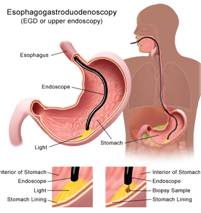 gastroscopy-image