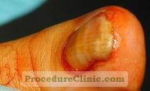 nail disease