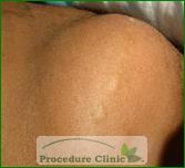 Lipoma