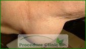 lipoma