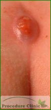pilonidal cyst