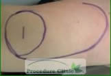 Rotation flaps - before surgery