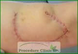 Rotation flaps - after surgery