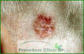 Rhomboid - Skin Cancer
