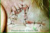 Rhomboid - After Surgery