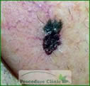 Melanoma - before Surgery