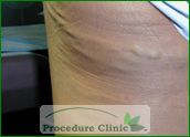 sclerotherapy