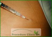 sclerotherapy