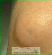 Sebaceous Cyst