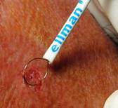 Shaving EXcision