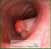 Colon Polyp