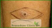 Fusiform excision - before surgery