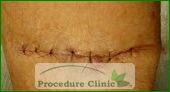 Fusiform excision - after surgery